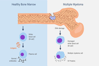 Multiple Myeloma treatment